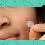 These 5 Pimple Patches are Nigerian Favourites for Their Price and Effectiveness
