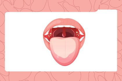 The Gross Truth About Tonsil Stones (and Why They Make Your Breath Smell)