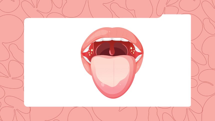 The Gross Truth About Tonsil Stones (and Why They Make Your Breath Smell)