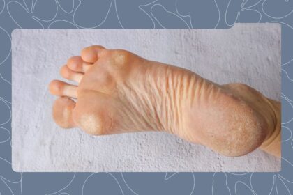 Safe and Effective Ways to Remove Callus From Your Feet